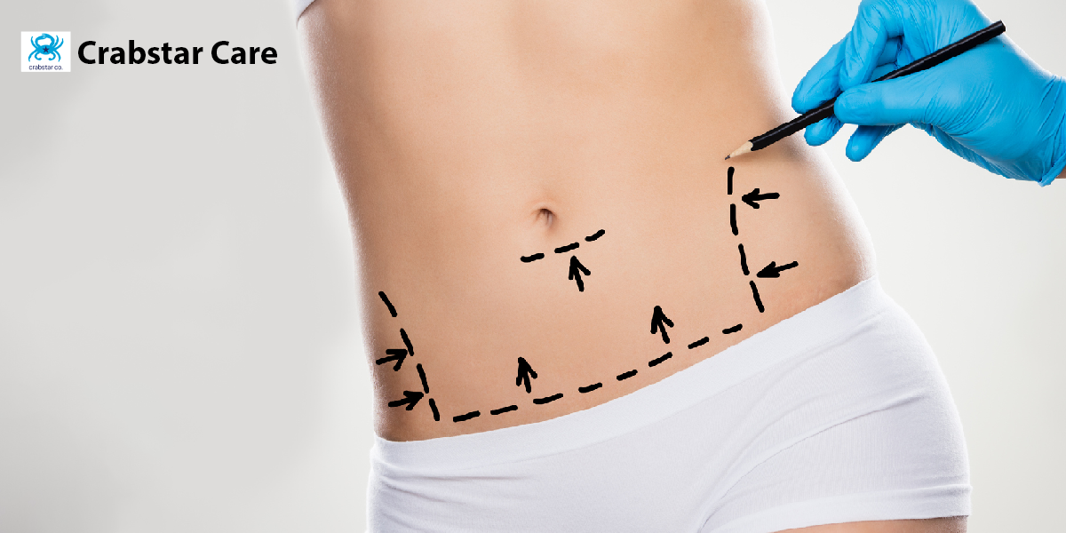 What are the Best Practices for Post-Op Care After Tummy Tuck?
