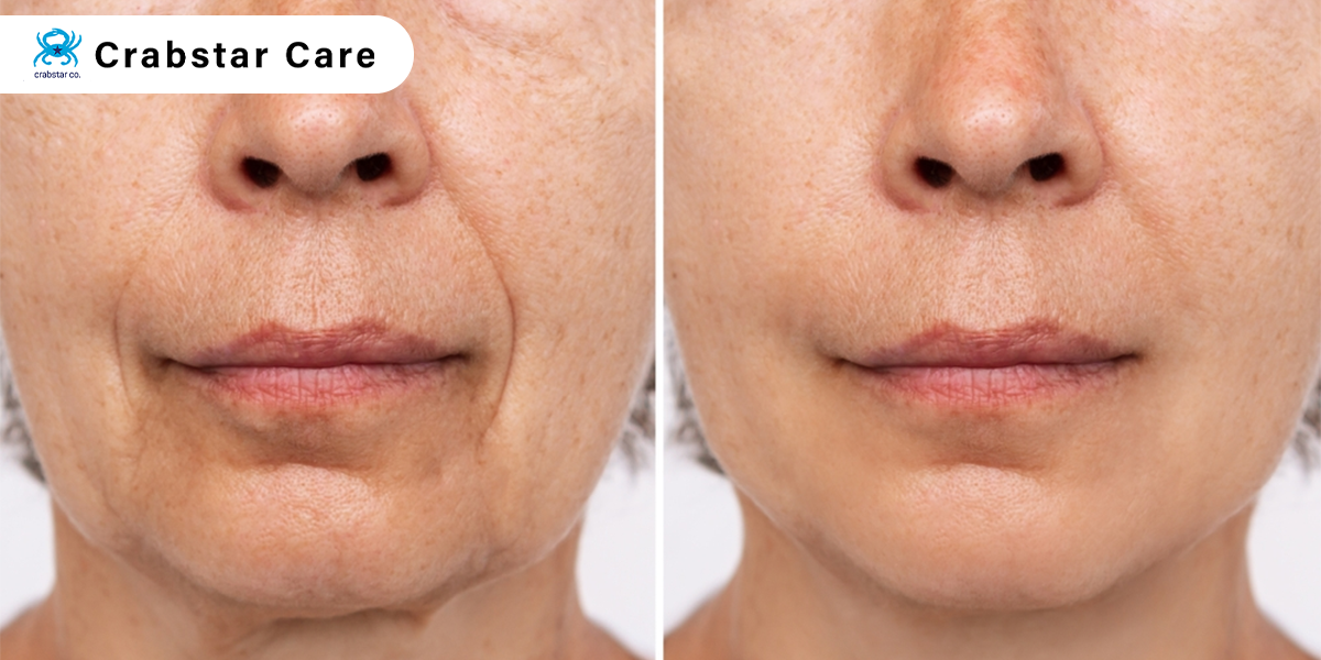 Face Lift Post Operative Care: Ensuring a Smooth Recovery with Crabstar Care