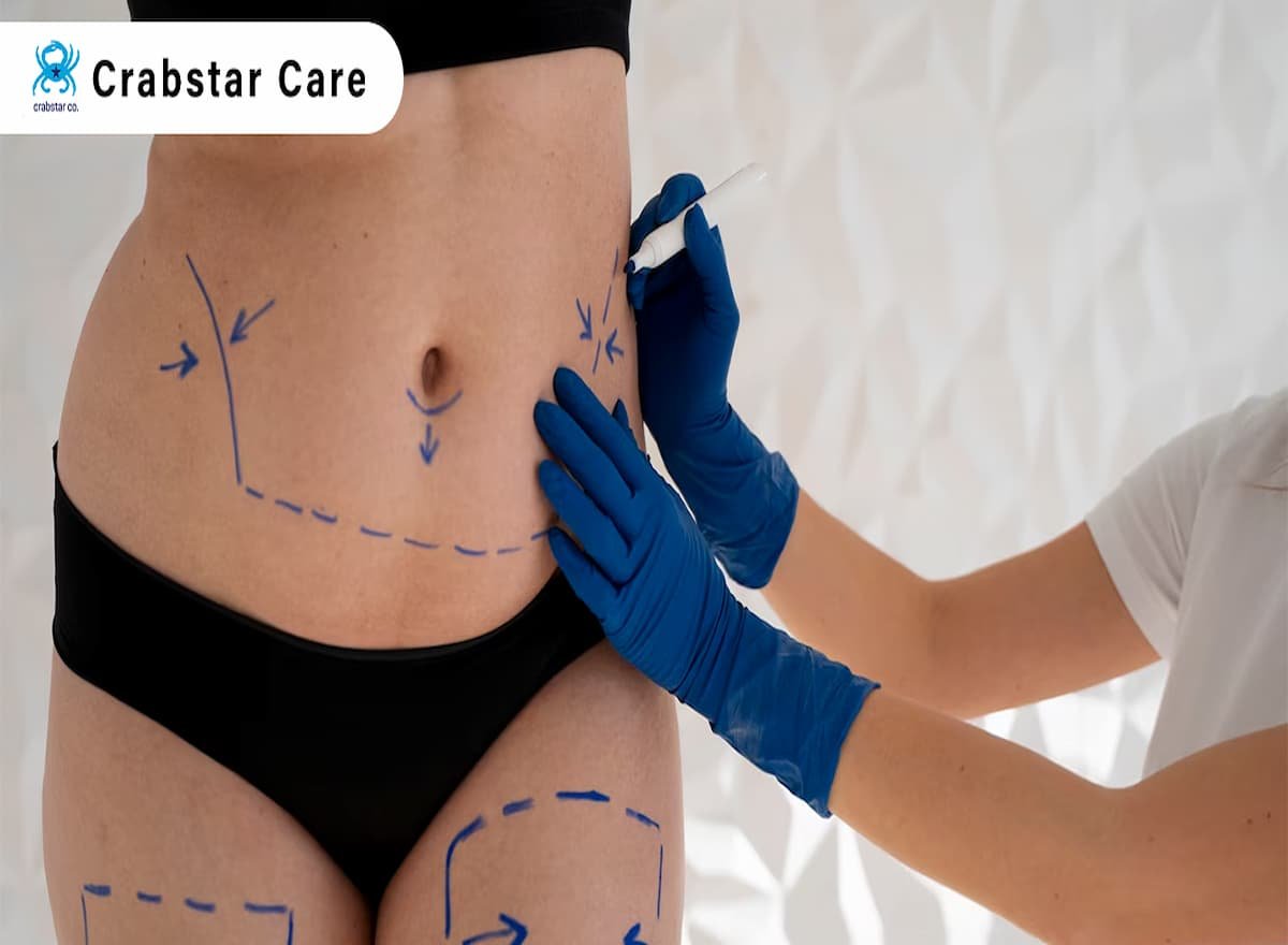 Post-Op Care for Tummy Tuck in Palo Alto: What You Need to Know?