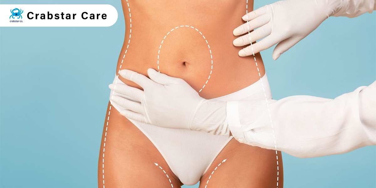 Post Liposuction Care Services in Palo Alto, CA: Your Path to a Confident Recovery