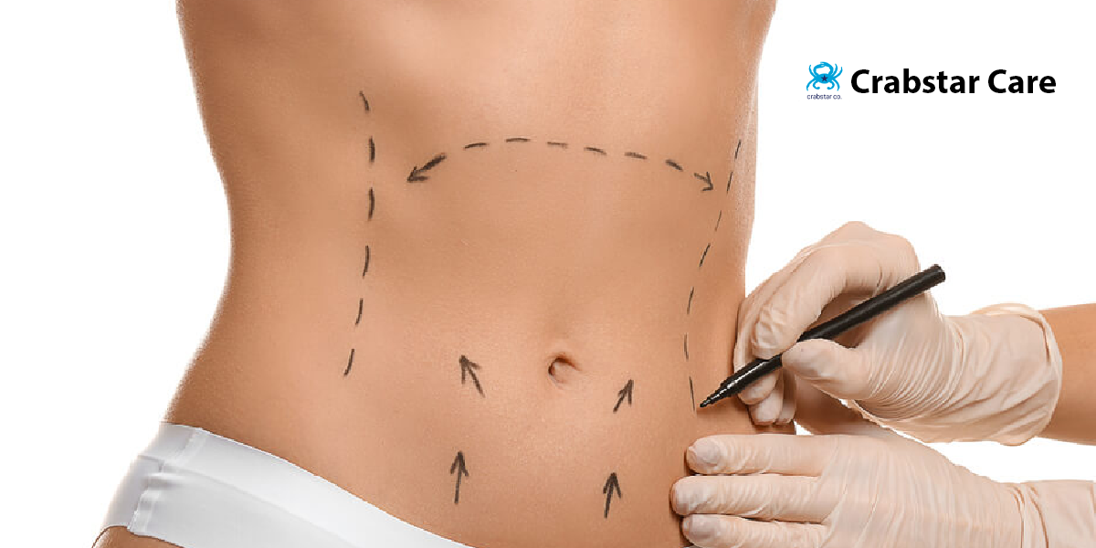 Why is Post-Liposuction Care Important in Palo Alto CA?